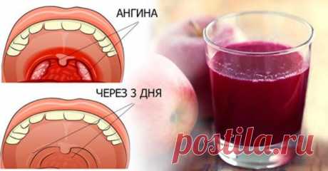 Лечим ангину в домашних условиях без антибиотиков. Натуральное средство уберет боль в горле. Бывает, проснешься утром — и понимаешь, что заболел. Горло болит так, что невозможно глотать, боль отдает в виски, и разговаривать нормально не получается. Жуткое состояние. Что делать? Шутить с простуженным горлом точно не стоит. Чем раньше ты начнешь лечение, тем быстрее наступит выздоровление. Дни промедления только ухудшают ситуацию.  Что делать, если болит горло? Боль в горле ...