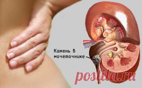Камни в почках - симптомы, диагностика и лечение.
