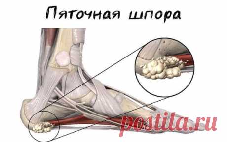 Пеленание от шпор