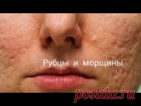 АПТЕЧНОЕ СРЕДСТВО. Чем убрать РУБЦЫ, ШРАМЫ, МОРЩИНЫ, РАСТЯЖКИ.