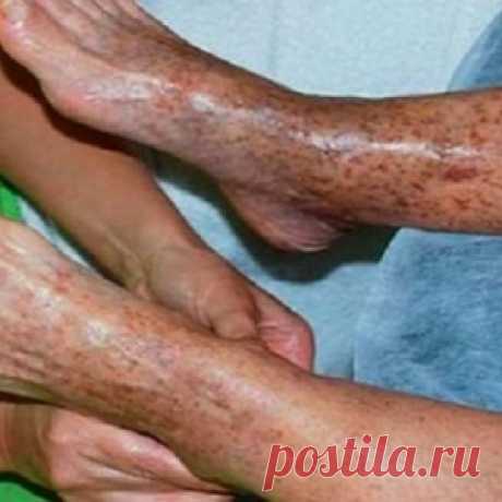 Эффективные советы о том, как решить проблему плохой циркуляции крови