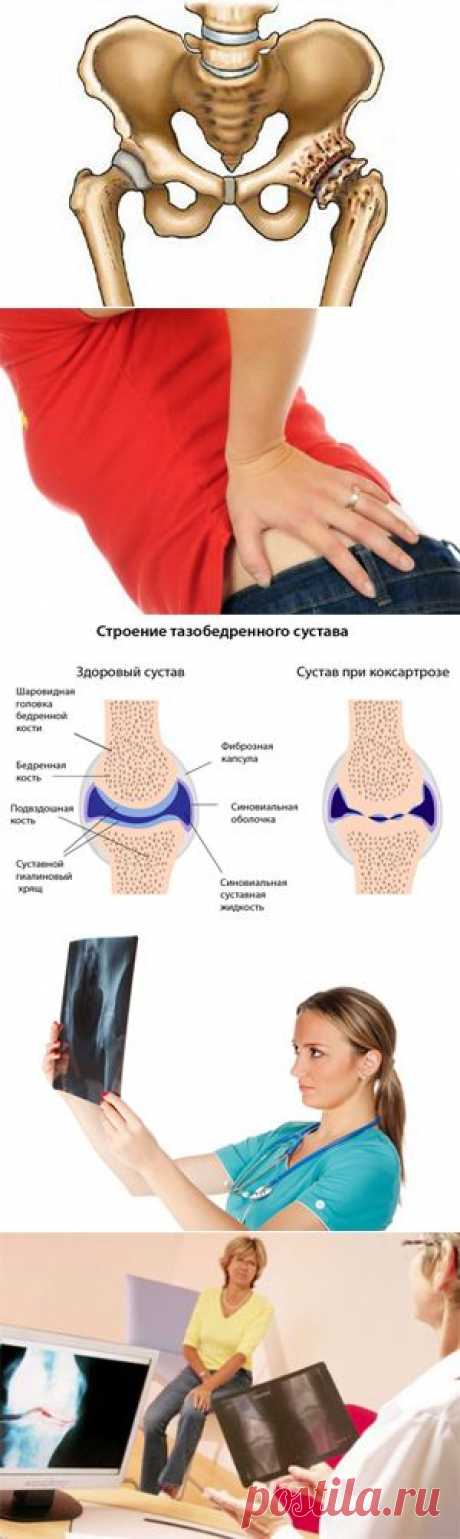 &gt;&gt; Коксартроз суставов – причины и симптомы коксартроза 1, 2 и 3 степени. Как лечить?