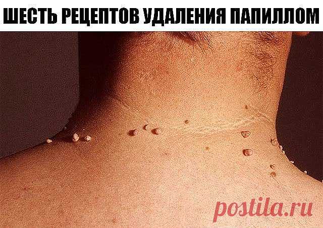 ШЕСТЬ РЕЦЕПТОВ УДАЛЕНИЯ ПАПИЛЛОМ ... 
Первый рецепт: Для избавления от папиллом в домашних условиях рекомендуется использовать порошок, приготовленный из хорошо просушенных семян расторопши, благотворно действующего на организм в целом. …