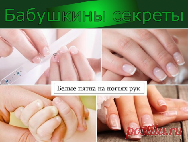 Белые пятна на ногтях рук: причины белых точек, полосок и полукругов на ногтях и под ними