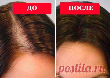 Чудо-средство от выпадения волос



Терпентин или живица – натуральная смола хвойных деревьев, которая в большом количестве содержит полезные вещества и эфирные масла.
Бесцветное вещество с вязкой структурой имеет характерный запах хвои, применяется в народной медицине при лечении ран, ожогов и воспалений кожи.