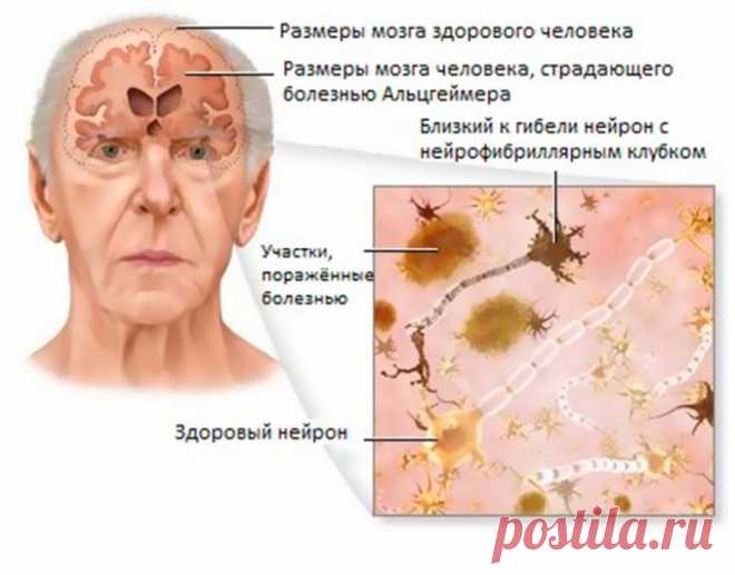 Как уберечь себя от болезни Альцгеймера / Будьте здоровы