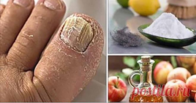 Лучшие домашние средства для удаления грибка ногтей! - Журнал для женщин Просто и эффективно! Одной из наиболее распространенных инфекций в наши дни, безусловно, является грибковая инфекция. Это начинается с белых или желтых пятен под кончиком ногтя. Он выглядит совершенно безвредным, но с углублением инфекции ноготь становится очень толстым, желтым и начинает ломаться. Если вы оставите его без лечения, это затронет несколько других ногтей. По мнению медицинских […]