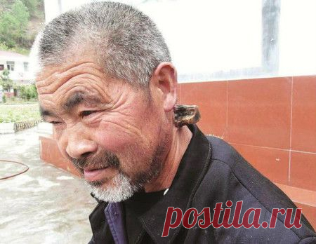 На шее у китайца вырос рог в 15 сантиметров. | Планета фактов