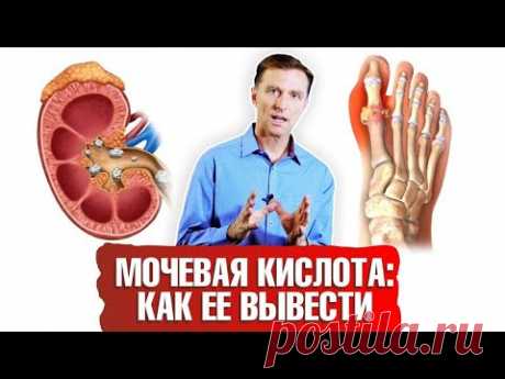 Мочевая кислота. Как вывести ее из организма? ☝️