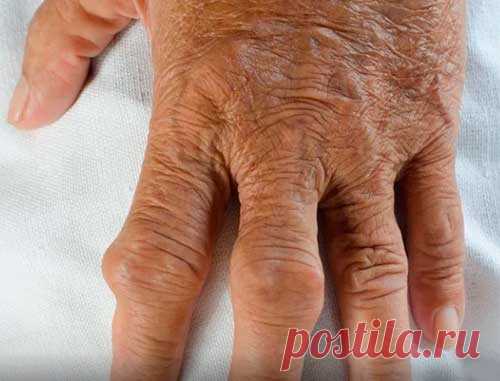 Подагра пальцев: что делать.
Подагра пальцев является редкой формой подагры. Основная причина - повышенное содержание мочевой кислоты в крови. Симптомы подагры пальцев. Меры профилактики.