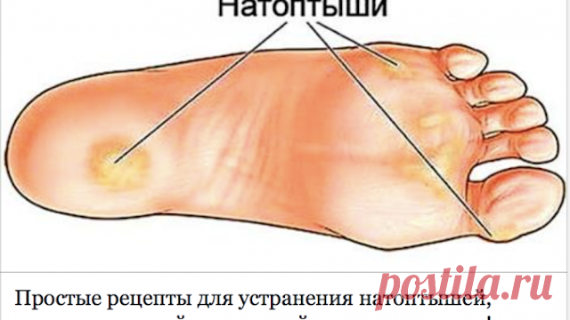 Простые Рецепты Для Устранения Натоптышей, Трещин, Мозолей, Сосудистой Сетки И Варикоза! После применения этих рецептов, мои стопы всегда в идеальном состоянии!

 

Одним из наиболее проблематичных частей человеческого тела является область лодыжек, ступней и ног. Они часто страдают от появления мозолей и трещин, а также подвержены риску развития варикозного расширения вен.

Такие
