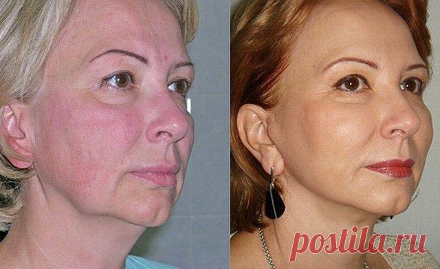 Уход за лицом. Как подтянуть брыли и разгладить морщины с помощью домашней маски? Простой рецепт