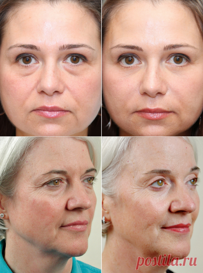 Блефаропластика (пластика век). Цены, отзывы, фото до и после