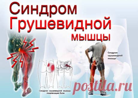 doclvs.ru | Синдром грушевидной мышцы: причины, симптомы, диагностика, лечение