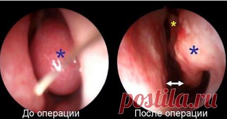 Вазотомия при вазомоторном рините, лазерная вазотомия
Вазотомия при вазомоторном рините - иногда это единственный способ избавиться от постоянной заложенности, насморка, преимущество, особенности лазерной вазотомии