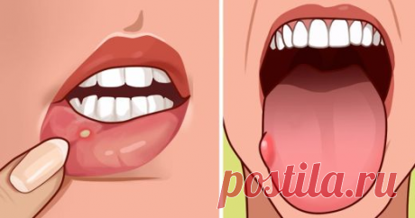 7 признаков дефицита фолиевой кислоты, которые многие игнорируют