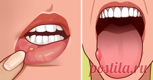 7 признаков дефицита фолиевой кислоты, которые многие игнорируют
