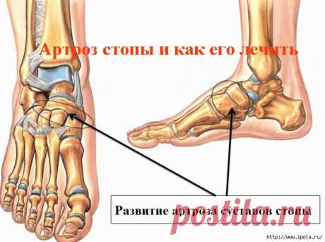 обратимых дегенеративных процессах. Данная гимнастика направлена на решение таких задач:9. Сядьте на пол, ровную спину прислоните к спине. Ноги разведите максимально широко. Пораженную ногу согните в колене и начните сгибать его к полу вовнутрь. На 10 секунд зафиксируйтесь в нижнем положении, затем расслабьтесь. Повторите наклон четыре раза. Будучи в состоянии расслабления, можете поднажать на колено руками, чтоб сильнее нагнуть ногу. Это