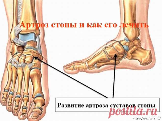 Артроз стопы и как его лечить
