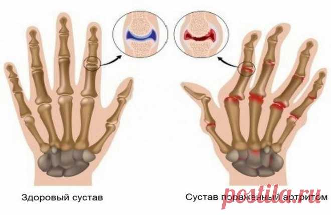 Суперлечение - картофель на кефире против артрита