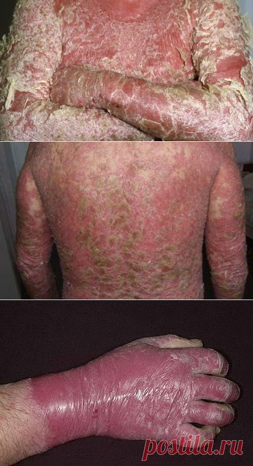 Псориатическая эритродермия, причины, лечение, симптомы