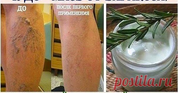 Чудо - мазь от варикоза     Девочки, я хоть и медик, но тут столкнулась с проблемой. У моей мамы жуткий варикоз. И врачи сказали - только операция. А она - ни в как...