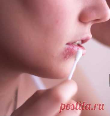 Вылечить герпес в домашних условиях-Журнал полезных совет