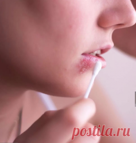 Вылечить герпес в домашних условиях-Журнал полезных совет