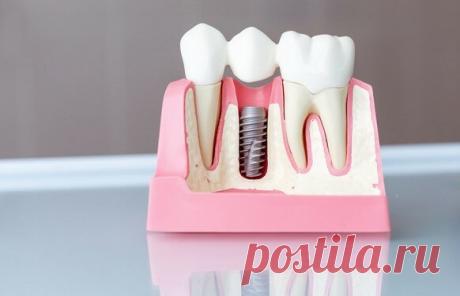 Правда, что зубные импланты можно устанавливать «без разрезов»?
🔎 Коротко Не совсем. Полностью избежать хирургических разрезов слизистой можно только в одном случае: если ставить имплант в лунку только что удаленного зуба. В ситуации, когда зуб был удален давно и ткани уже зажили, установить имплант, не разрезая десну, нельзя. Но можно провести операцию с наименьшей травмой. Такая методика имплантации называется безлоскутной. Именно ее обычно […]
Читай дальше на сайте. Жми подробнее ➡