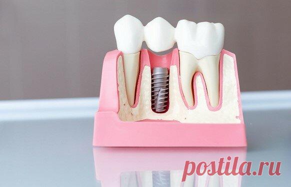 Правда, что зубные импланты можно устанавливать «без разрезов»?
🔎 Коротко Не совсем. Полностью избежать хирургических разрезов слизистой можно только в одном случае: если ставить имплант в лунку только что удаленного зуба. В ситуации, когда зуб был удален давно и ткани уже зажили, установить имплант, не разрезая десну, нельзя. Но можно провести операцию с наименьшей травмой. Такая методика имплантации называется безлоскутной. Именно ее обычно […]
Читай дальше на сайте. Жми подробнее ➡