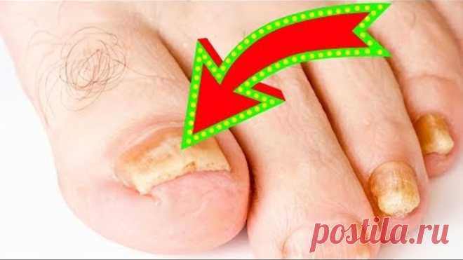 Аптеки РАЗОРЯТСЯ! ГРИБОК Боится, КАК Огня ОБЫЧНОГО...Супер-СРЕДСТВО!