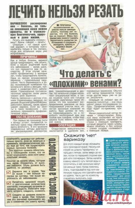 Варикоз