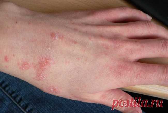 Лучшие природные антигистаминные препараты для борьбы с аллергическими реакциями! Вы страдаете от сезонной аллергии? Возможно, вы задавались вопросом, есть ли какие-либо естественные антигистамины, которые вы можете попробовать вместо