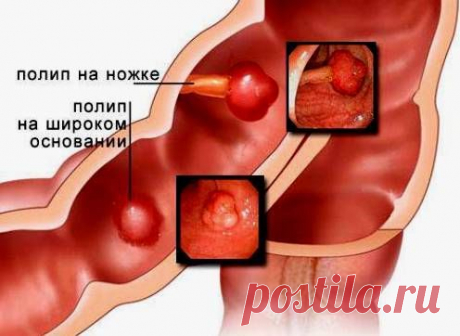 Полипы в кишечнике, лечение народными средствами