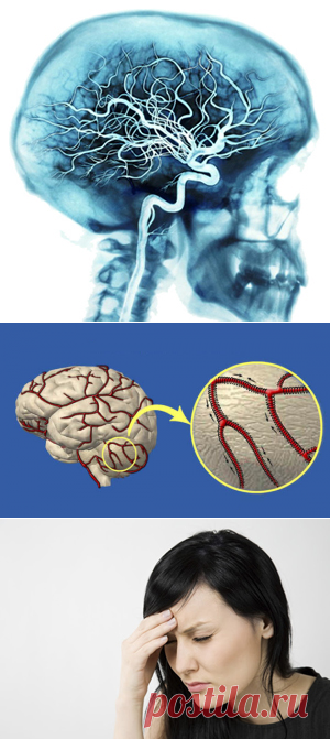 Чистка сосудов головного мозга в домашних условиях