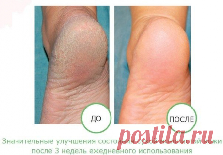 ПРОСТОЙ И ОЧЕНЬ ЭФФЕКТИВНЫЙ ДОМАШНИЙ КРЕМ ДЛЯ НЕЖНЫХ ПЯТОЧЕК!
