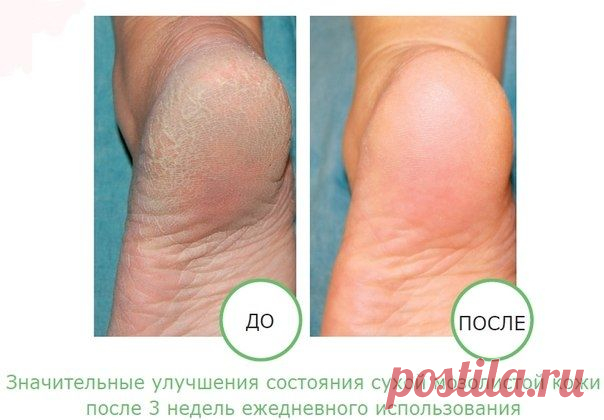 ПРОСТОЙ И ОЧЕНЬ ЭФФЕКТИВНЫЙ ДОМАШНИЙ КРЕМ ДЛЯ НЕЖНЫХ ПЯТОЧЕК!