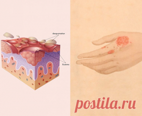 Как лечить дерматит и экзему без гормонов