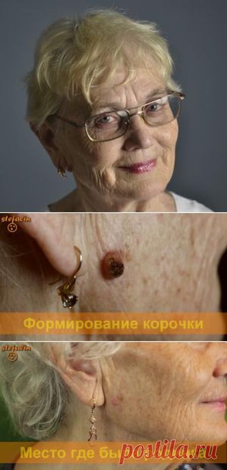 Валентина Исаева, Бердянск - делимся опытом удаления родинок
Я довольна. Спасибо Ларисе за консультации. Она мне помогала, контролировала весь процесс.

Соответственно я согласилась записать интервью, где рассказываю и показываю след от удаления родинки.