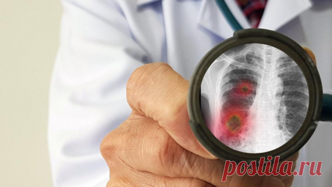 Эффективное восстановление лёгких после COVID-19
Covid-19 истощает организм и негативно отражается на состоянии дыхательной системы. Победив болезнь, важно знать, как восстановить лёгкие после коронавируса. Самые действенные методы мы уместили в несколько абзацев для вашего удобства. источник: Shutterstock Общие сведения о коронавирусе Новый вид вируса 2019-ncoV был зафиксирован в декабре 2019 года в Китае в городе Ухань, и весьма быстро адаптировался […]
Читай дальше на сайте. Жми подробнее ➡