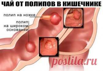 Чай от полипов в Кишечнике