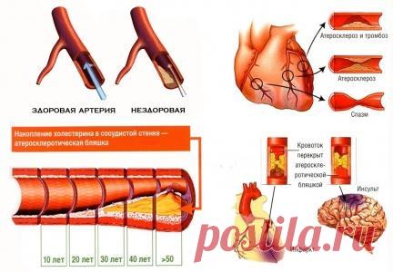Атеросклероз! Что это такое и как с ним бороться