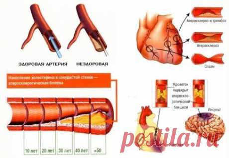 Атеросклероз! Что это такое и как с ним бороться