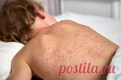 Дети из России оказались в больнице на Бали в тяжелом состоянии из-за вспышки кори в школе