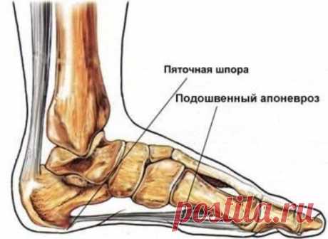Народные рецепты для лечения пяточной шпоры