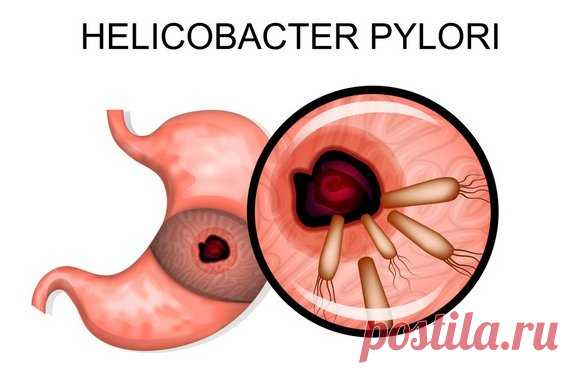 - Helicobacter pylori - как бороться естественным способом без лекарств -
