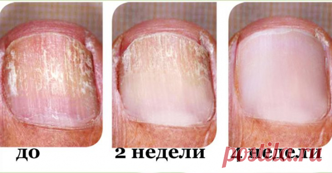 Заметили грибок на ногтях? Действуй немедленно и устрани его быстро!
Природные средства для борьбы и лечения ГРИБКА и инфекций! Грибок ногтя является типом грибковой инфекции, которая возникает, когда дерматофиты грибок начинает расти под ногтем. Как правило, в результате чего ноготь становится толстым, искаженным и желтым. По мере ухудшения инфекции ноготь на пальце ноги может быть отделен от...
Читай пост далее на сайте. Жми ⏫ссылку выше