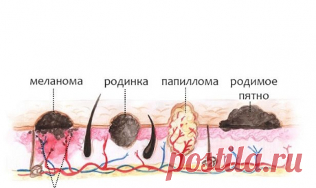 8 простых способов удаления папилломы, не посещения врача 



Проверенные методы!








Папиллома — это общее состояние кожи, вызванное чрезмерным ростом тканей кожи. Эти дополнительные куски кожи безвредны. Они часто появляются после 35, чаще всего в тех …