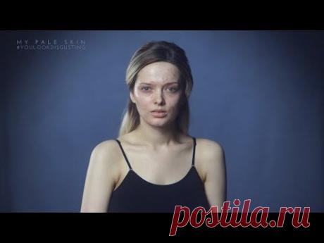 ▶ YOU LOOK DISGUSTING - YouTube Девушка с проблемной кожей сняла мощное видео после того, как получила шквал оскорбительных комментариев по поводу её лица.