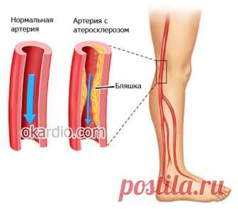 Перемежающаяся хромота: причины, классификация, симптомы и лечение